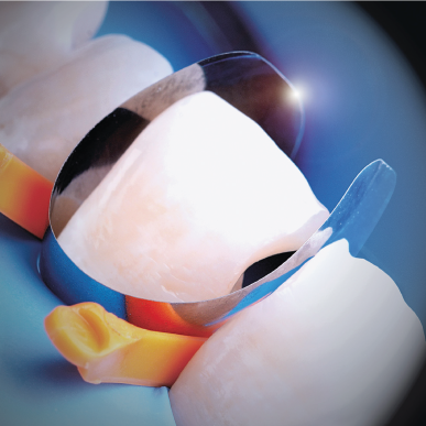 Matrice Composite Cervicale Inter-Proximale Classe V | ZTD032