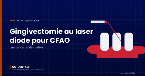 Laser diode et gingivectomie péri-prothétique : protocole et apport en CFAO